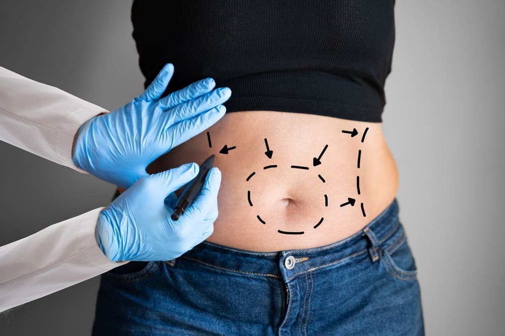 A Practical Guide to Abdominal Liposuction vs. Tummy Tuck - Bellevue ...