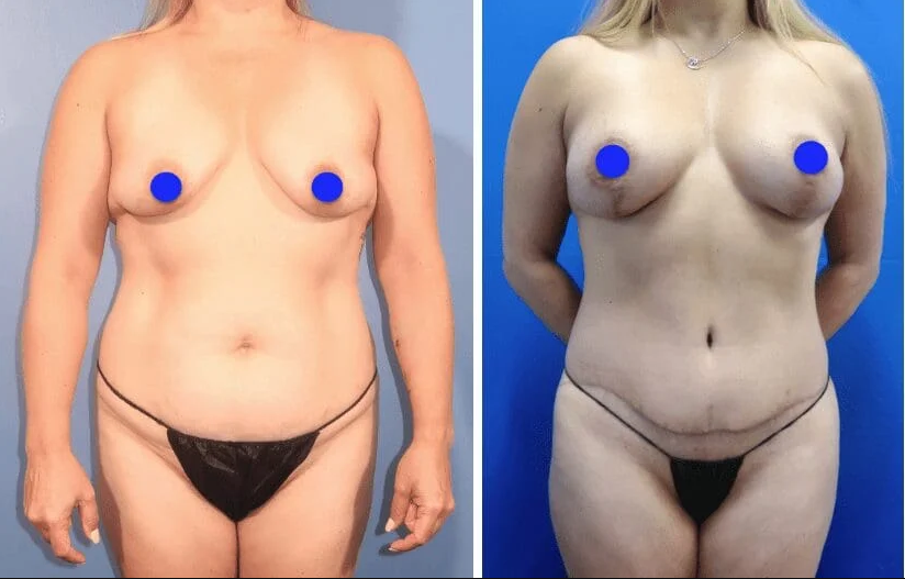 Understanding the lollipop breast lift: a comprehensive guide by dr. Kristopher m. Day, md, facs