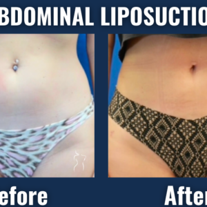 Before and after results of abdominal liposuction showing flatter stomach and defined waistline in a female patient.