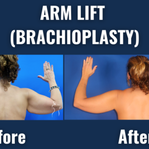 Before and after results of arm lift surgery (brachioplasty) showing significant reduction in upper arm sagging, viewed from the back.