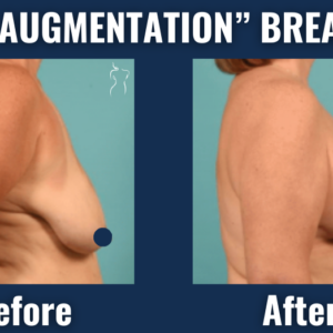 Before and after images of auto-augmentation breast lift showing enhanced breast projection and contour from side profile without implants.