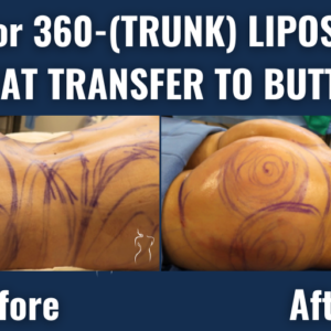 Before and after results of bbl with 360-degree trunk liposuction and fat transfer to buttocks showing improved body contour and enhanced gluteal volume.