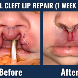 Before and after image showing bilateral cleft lip repair in an infant one week after surgery, with visible improvements in lip alignment and structure.