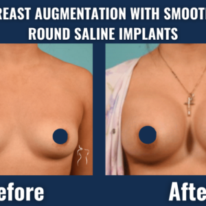 Before and after results of breast augmentation with smooth, round saline implants showing enhanced breast volume and contour from the front view.