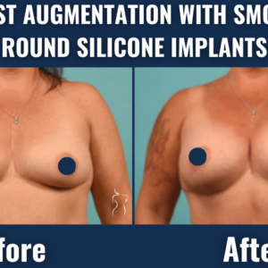 Before and after results of breast augmentation with smooth, round silicone implants showing increased breast size and improved contour.
