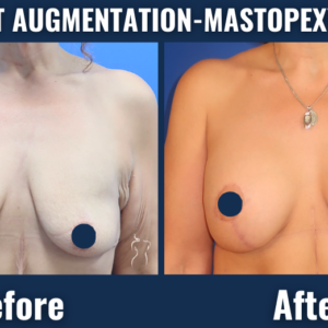 Before and after photo of a breast augmentation-mastopexy (lift) procedure showing improved breast shape, symmetry, and volume.