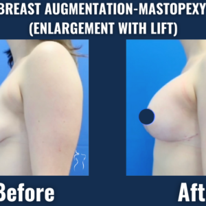 Before and after side profile showing results of breast augmentation with lift (mastopexy) using implants.