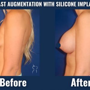 Visual comparison of breast augmentation results with silicone implants, demonstrating increased breast volume and improved body contour while maintaining natural appearance.