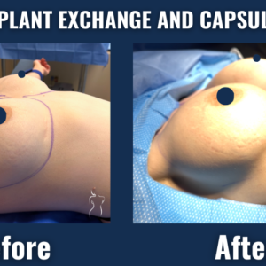 Before and after intraoperative photos of breast implant exchange with capsule shaping showing enhanced implant placement and breast contour.