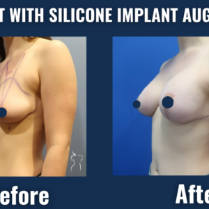 Before and after side view of breast lift with silicone implant augmentation showing enhanced breast shape, volume, and lifted position.