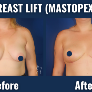 Before and after breast lift (mastopexy) images showing uplifted breast shape and improved nipple alignment in a female patient.