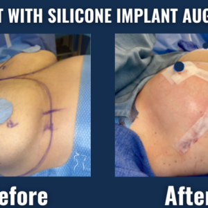 Before and after surgical view of breast lift with silicone implant augmentation showing improved breast volume and contour.
