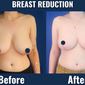 Front view before and after breast reduction surgery showing smaller, lifted breasts with improved symmetry.