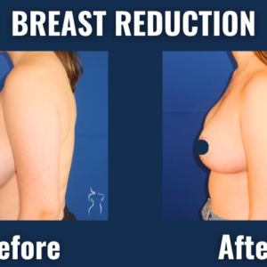 Side view before and after results of breast reduction surgery showing lifted, smaller breasts and improved body contour.