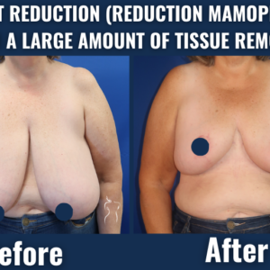 Breast-reduction-reduction-mammoplasty-large-tissue-removal-before-after