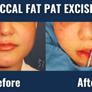 Before and after images of buccal fat pad excision showing cheek reduction and improved facial contour in a female patient.