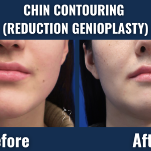 Before and after results of chin contouring via reduction genioplasty showing improved facial balance and a refined chin profile.