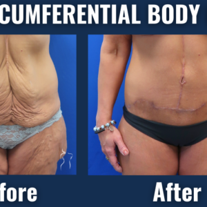 Before and after results of circumferential body lift surgery showing removal of sagging skin and improved body contour in a female patient after weight loss.