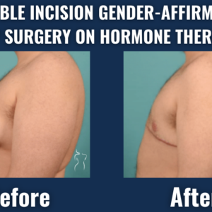 Before and after images of double incision gender-affirming top surgery showing a flat, masculine chest in an ftm patient on hormone therapy.