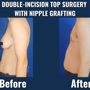 Gender-affirming surgery (ftm/n top surgery before & after)