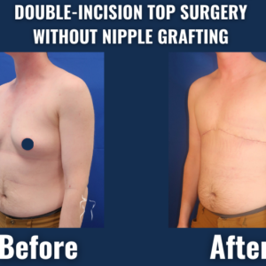 Comparison of chest appearance before and after double-incision top surgery without nipple grafting, showing a flat masculine contour and healed incision lines.
