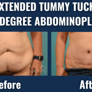 Before and after results of extended tummy tuck (270-degree abdominoplasty) showing improved abdominal shape and removal of loose skin in a female patient.