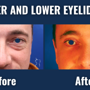 Before and after photos of male upper and lower eyelid lift (blepharoplasty) showing reduced puffiness and youthful eye contour.