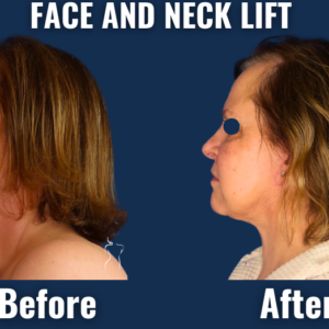 Before/after comparison of a face and neck lift, demonstrating natural rejuvenation of the lower face, sharper jawline, and smoother neck contours.