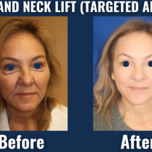 Visual comparison showing rejuvenating effects of a face and neck lift, with enhanced jawline definition, smoother neck contours, and natural-looking facial refreshment.