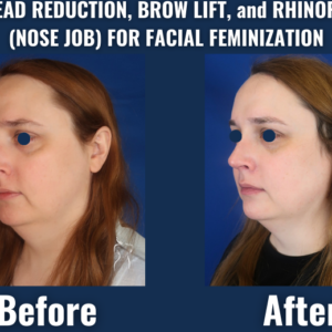Side-by-side before and after image of facial feminization surgery showing changes to the forehead, brows, and nose.