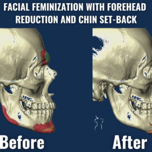 X-ray view showing before and after results of facial feminization surgery with forehead contouring and chin setback.
