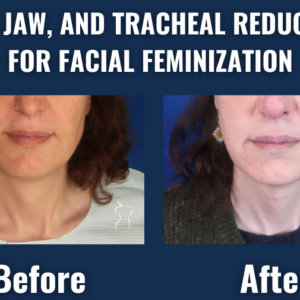 Facial-feminization-surgery-chin-jaw-tracheal-reduction-before-after
