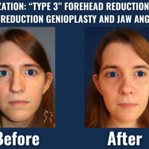 Before and after image of facial feminization surgery including type 3 forehead reduction, rhinoplasty, jaw angle reduction, and chin contouring.