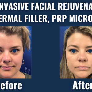 Before and after results of non-invasive facial rejuvenation with botox, dermal filler, and prp microneedling showing enhanced skin texture and youthful volume.