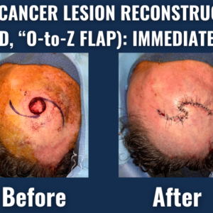 Before and after image of forehead skin cancer lesion repair using o-to-z flap technique for immediate surgical closure.
