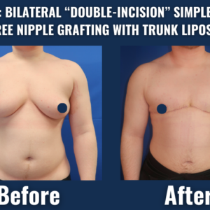 Before and after image of a transgender man showing results of top surgery with bilateral double-incision mastectomy and free nipple grafting, including trunk liposuction.