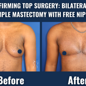 Before and after image of gender-affirming top surgery with bilateral double-incision mastectomy and free nipple grafting showing a flatter, masculinized chest.