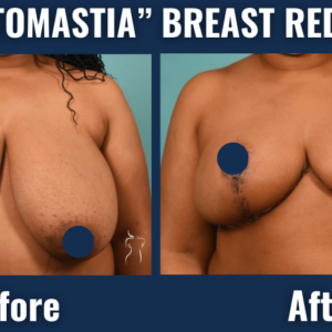 Before and after images of breast reduction surgery for gigantomastia showing decreased breast volume and post-surgical contour improvement.