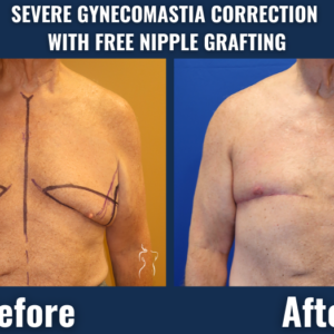Before and after photos of severe gynecomastia correction with free nipple grafting, showing improved male chest contour and reduced breast tissue.