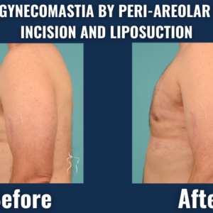 Before and after results of gynecomastia correction using peri-areolar incision and liposuction showing a flatter, more defined male chest.