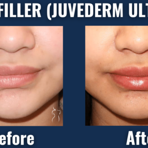 Before and after photos of juvederm ultra lip filler treatment showing natural-looking fuller lips and improved lip shape.