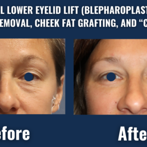 Before and after image showing lower eyelid lift with fat removal, cheek fat grafting, and canthopexy to reduce eye bags and smooth the under-eye region.