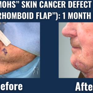 Before and after image of chin skin cancer defect repair using rhomboid flap technique one month after mohs surgery.