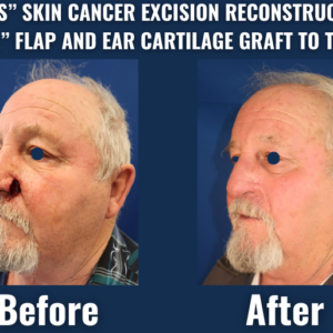 Before and after comparison of left nasal reconstruction after mohs surgery, featuring a nasolabial flap and ear cartilage graft to restore natural nasal contour.