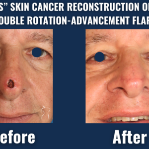Before and after images of a male patient showing nasal tip skin cancer reconstruction using double rotation-advancement flaps after mohs surgery.