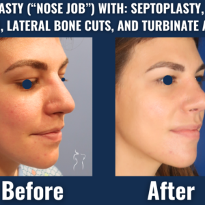 Side-by-side before and after photo showing rhinoplasty with septoplasty, spreader and tip grafting, and turbinate ablation for nasal profile enhancement.