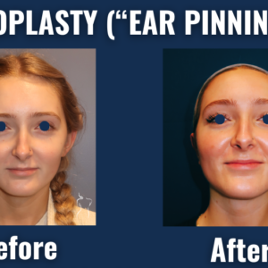 Front-facing before and after comparison of otoplasty (ear pinning) showing reduced ear projection and improved symmetry.