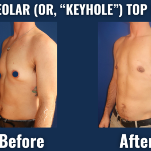 Before/after comparison of peri-areolar (keyhole) top surgery, demonstrating a masculinized chest with circular scars around the nipples and natural-looking contours.