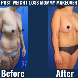 Before and after image showing post-weight-loss mommy makeover with breast enhancement and abdominal contouring.