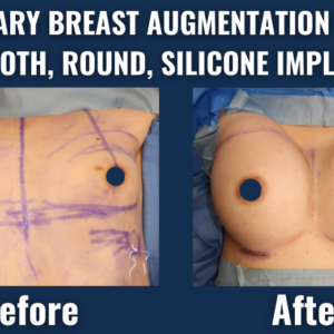 Before and after comparison of primary breast augmentation with smooth, round silicone implants, demonstrating increased breast volume and natural contour.